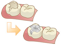 歯の治療前治療後